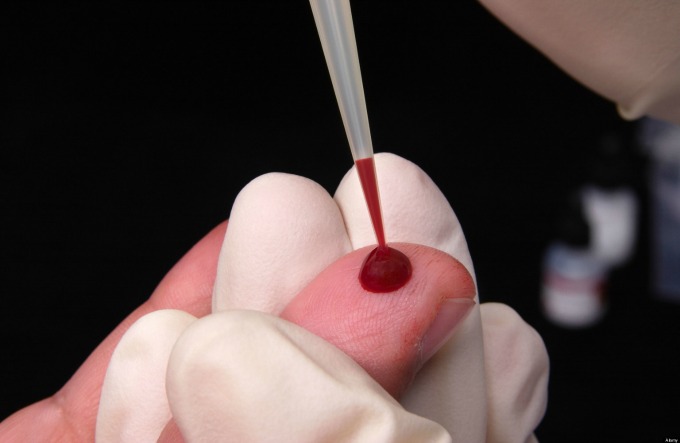 vađenje krvi Časopis Vangardist zaražen HIV om